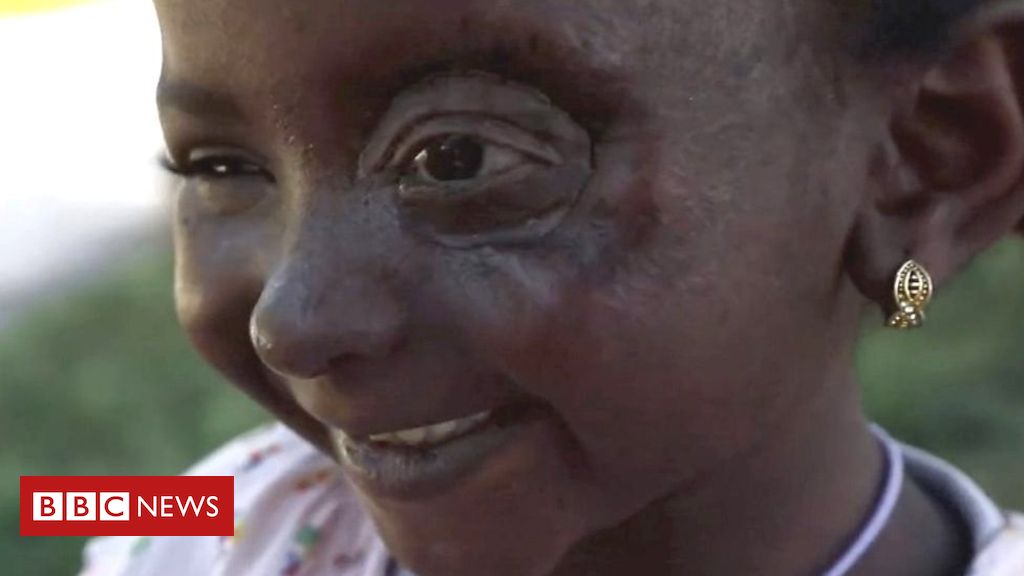 Yemen conflict: Six-year-old Yusra’s new eye
